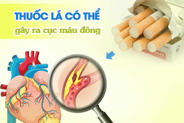 Thuốc lá có thể gây ra cục máu đông.